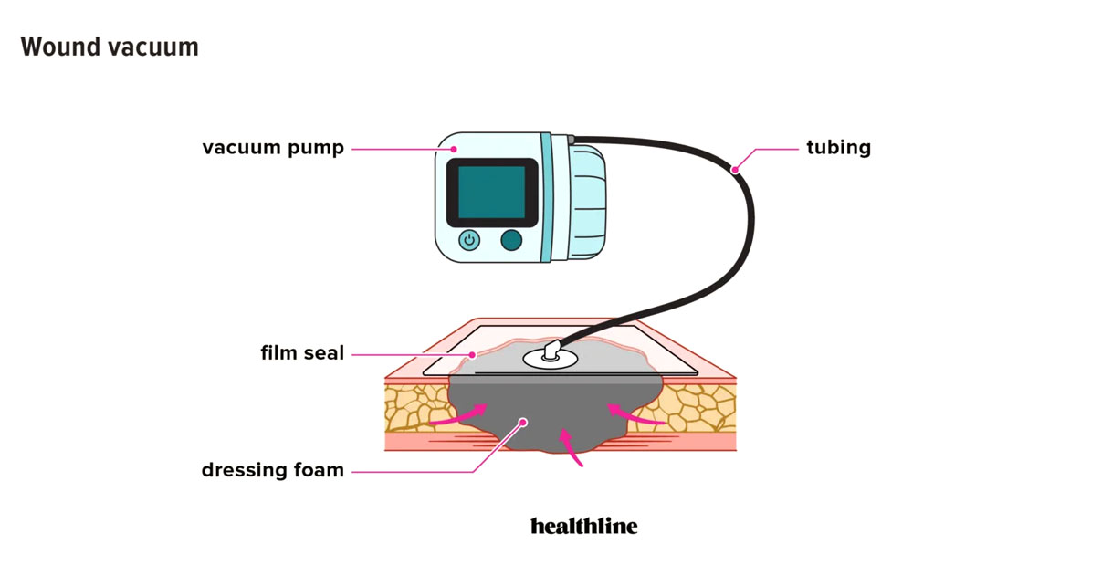 Negative pressure wound therapy pump